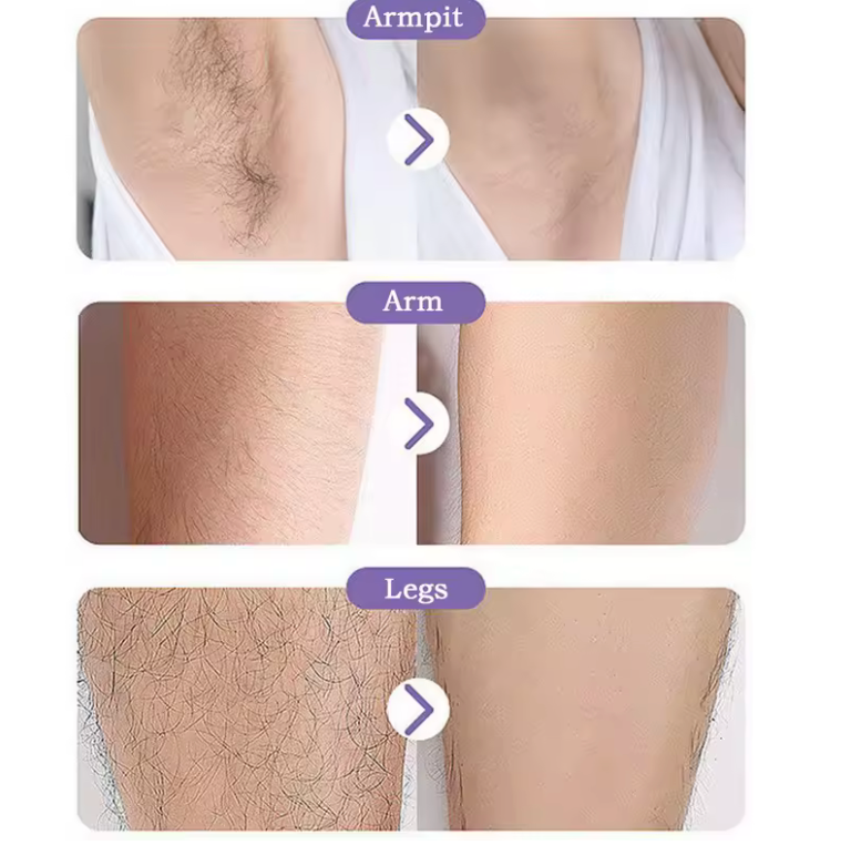 Nano-Epilator